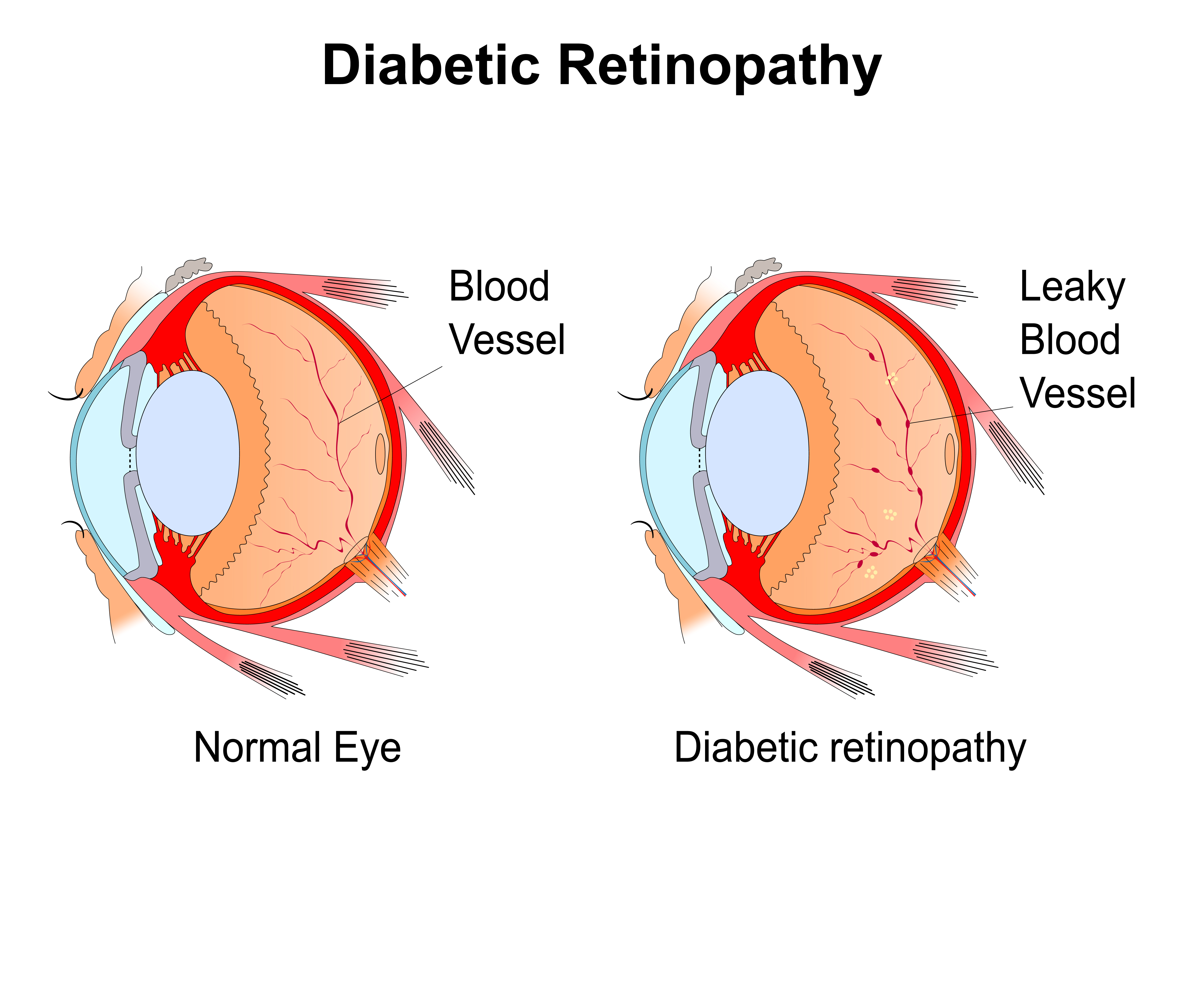 Diabetic Eye Exam | Ophthalmologist and Optometrist in Oklahoma City, OK